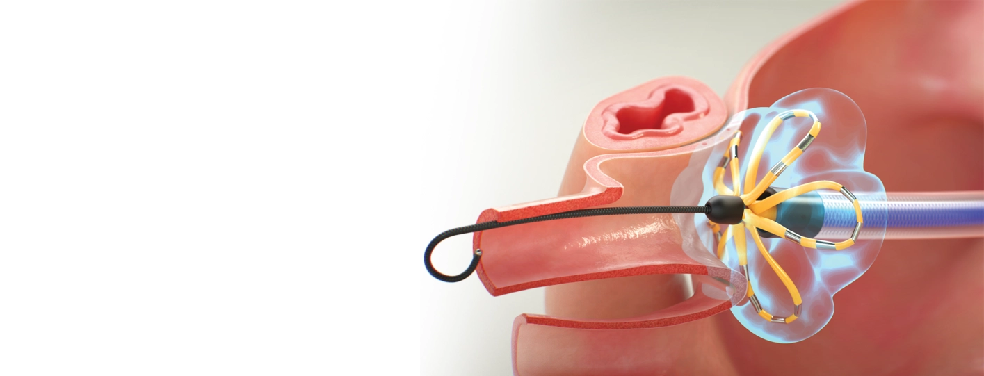 Catheter Ablation for Arrhythmia: A Minimally Invasive Treatment Option